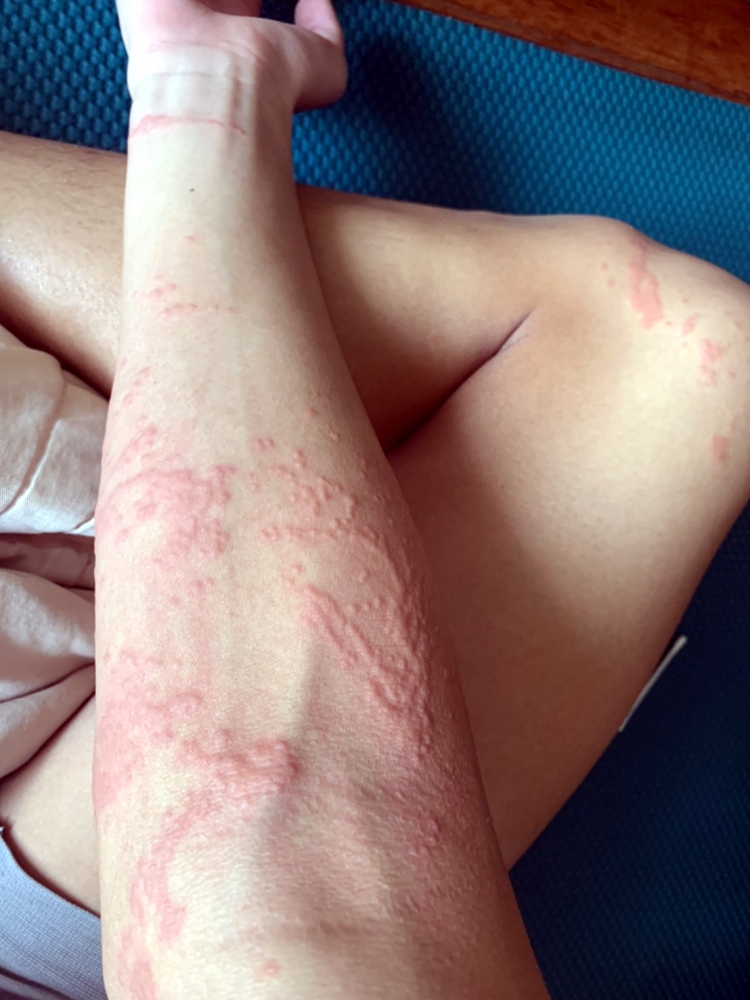 中華隊泳將出國前到基隆外海練海泳時被水母螯傷。中華民國游泳協會國際組/提供。